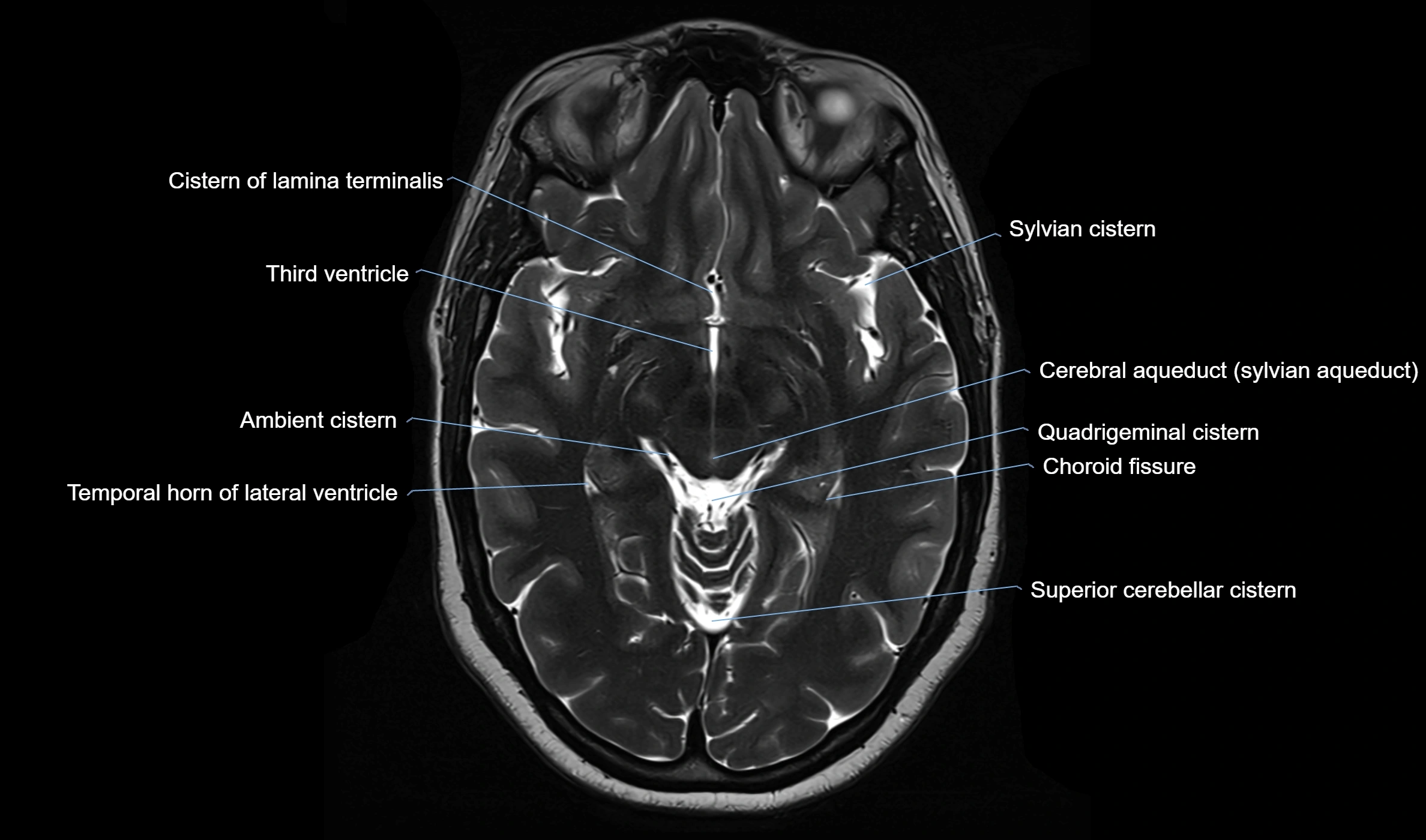 Brain cisterns  and ventricles  axial anatomy 3T MRI image-img-00001-00024.webp